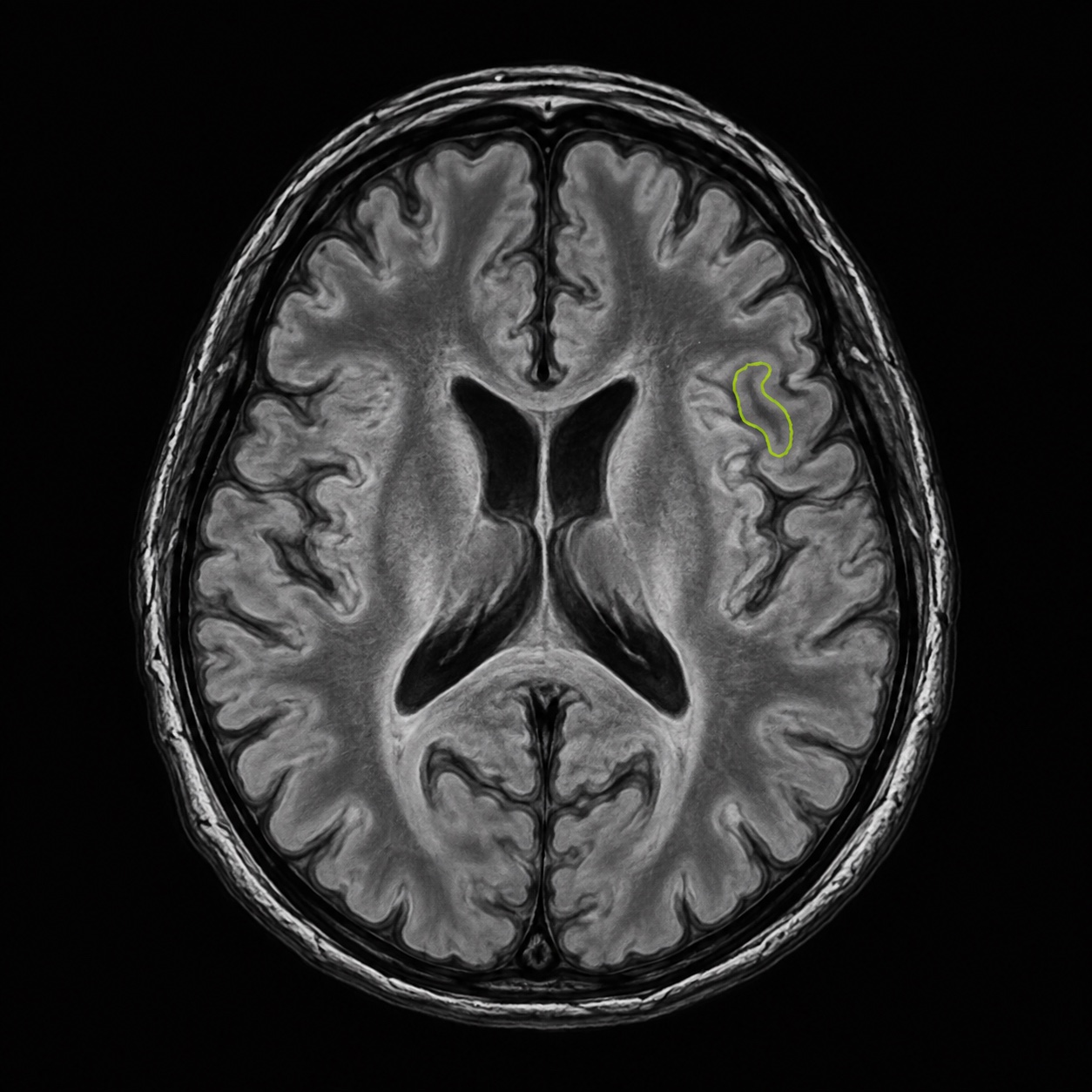 Conceptual grayscale brain scan with a lime annotation outline marking a small region